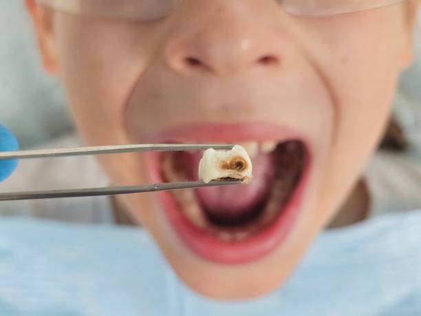 Best Knocked-Out Tooth (Avulsed Tooth) Treatment in Mexico, IN